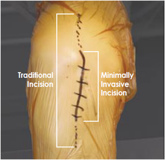 knee incision