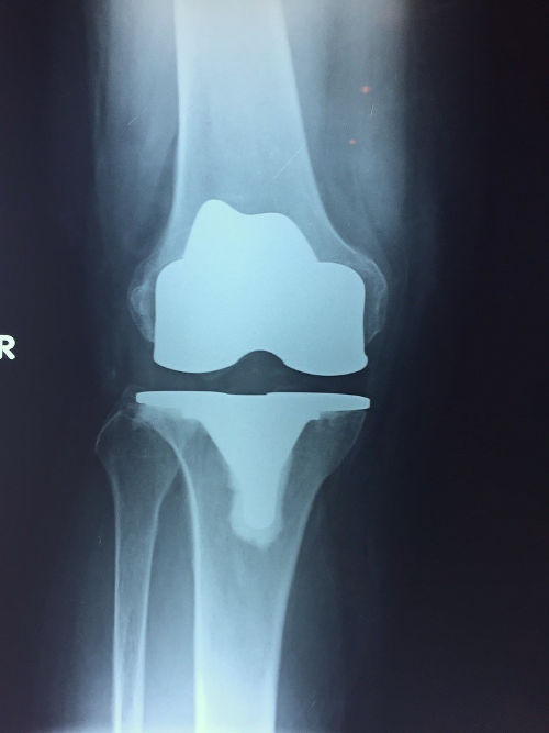 ακτινογραφία γόνατος με Ολική Αρθροπλαστική