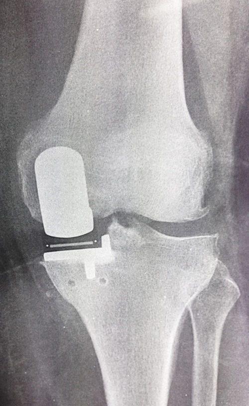 ακτινογραφία γόνατος με Μονοδιαμερισματική Αρθροπλαστική