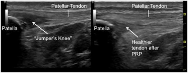 Υπερηχογράφημα επιγονατιδικού τένοντα πριν και μετά τη θεραπεία PRP