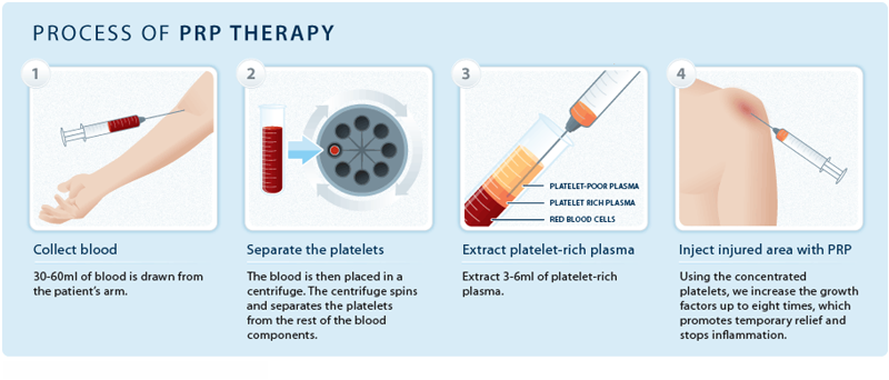 Διαδικασία θεραπείας PRP