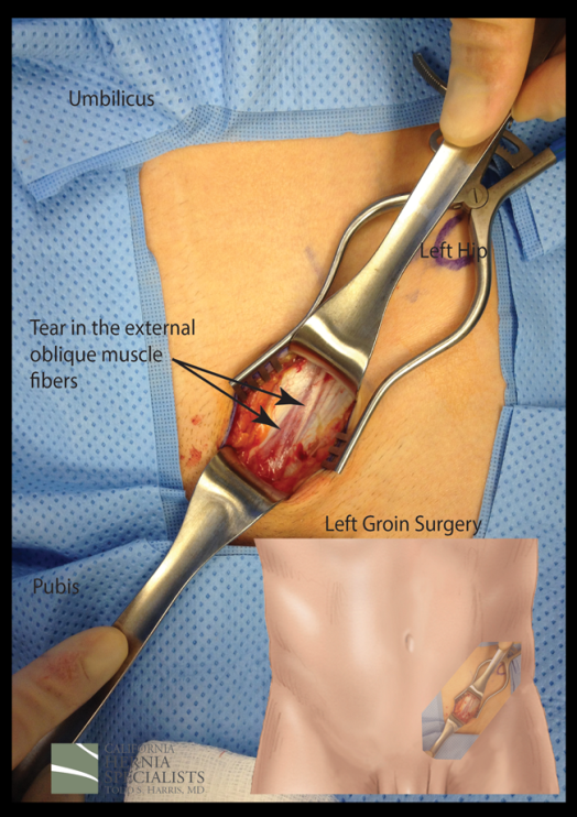 left groin surgery