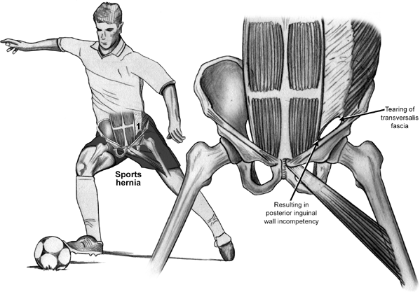 Sports Hernia 