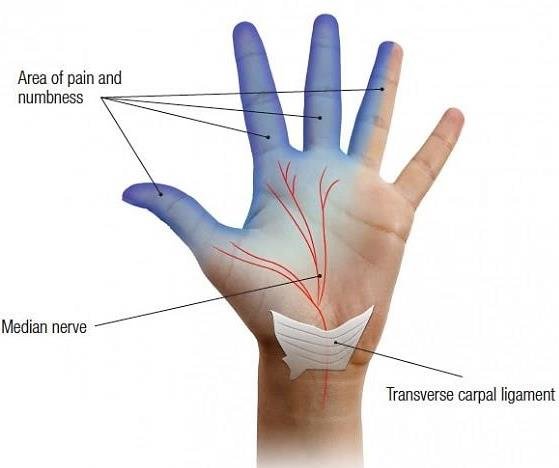 carpal tunnel syndrome