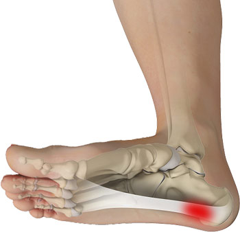 plantar fasciitis